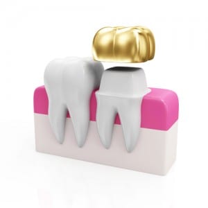 Mahkota Gigi yang Bermasalah- Global Estetik Dental Care